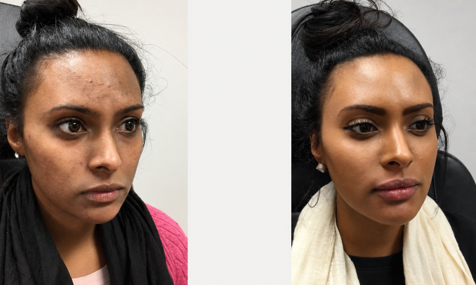 Before and after microneedling results showing more even skin tone
