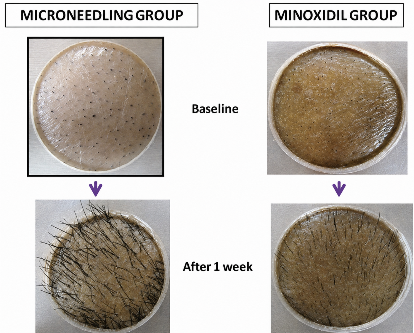 Clinical comparison showing microneedling group hair growth versus minoxidil group baseline and after 1 week results