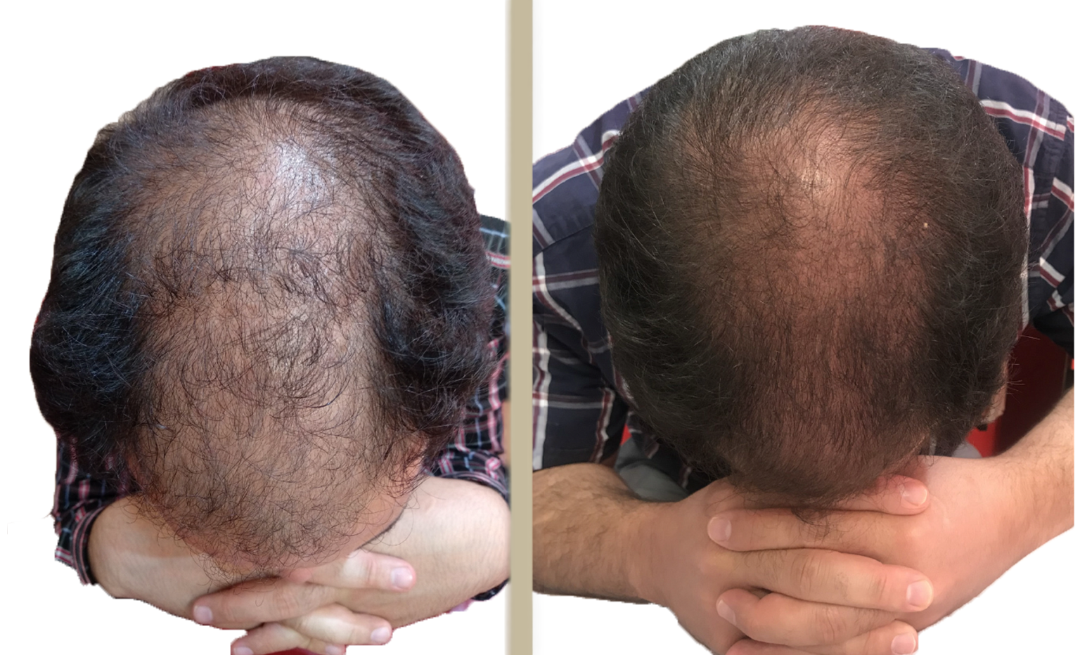 Hair restoration before and after result 1 — scalp microneedling at Acupuncture First