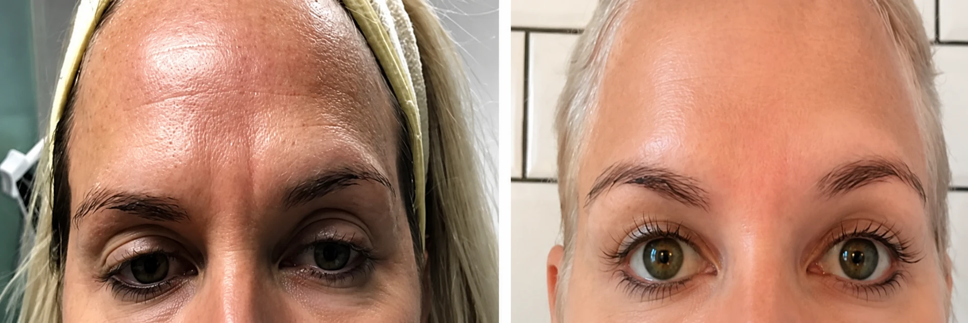 Before and after microneedling results showing smoother forehead lines