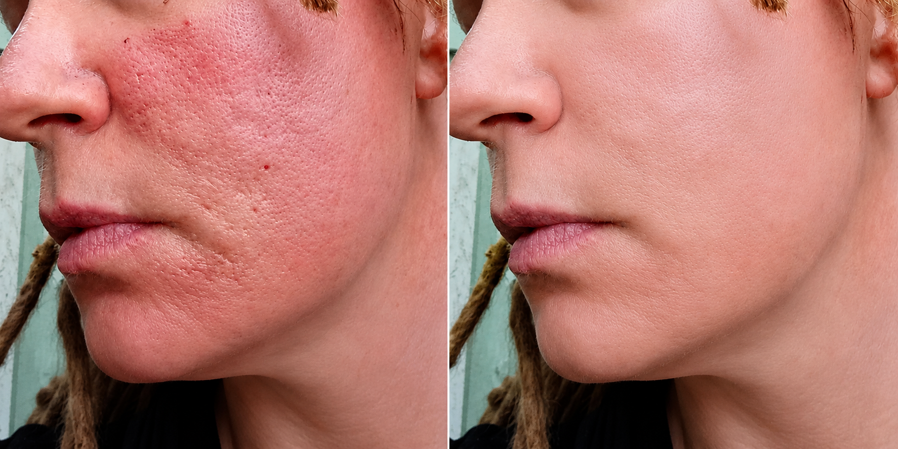 Before and after microneedling facial rejuvenation results showing clearer, smoother skin