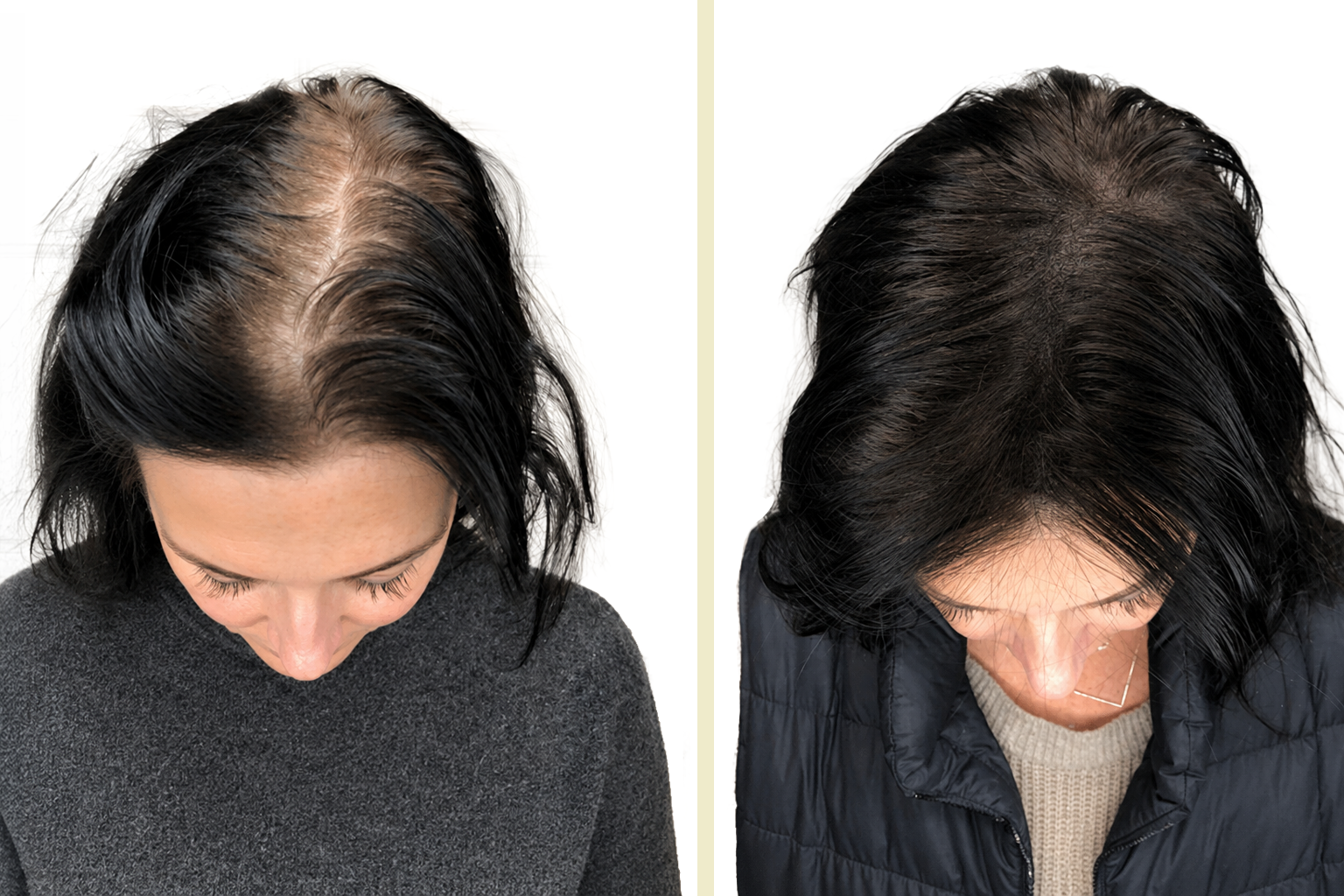 Hair restoration before and after result 3 — scalp microneedling at Acupuncture First