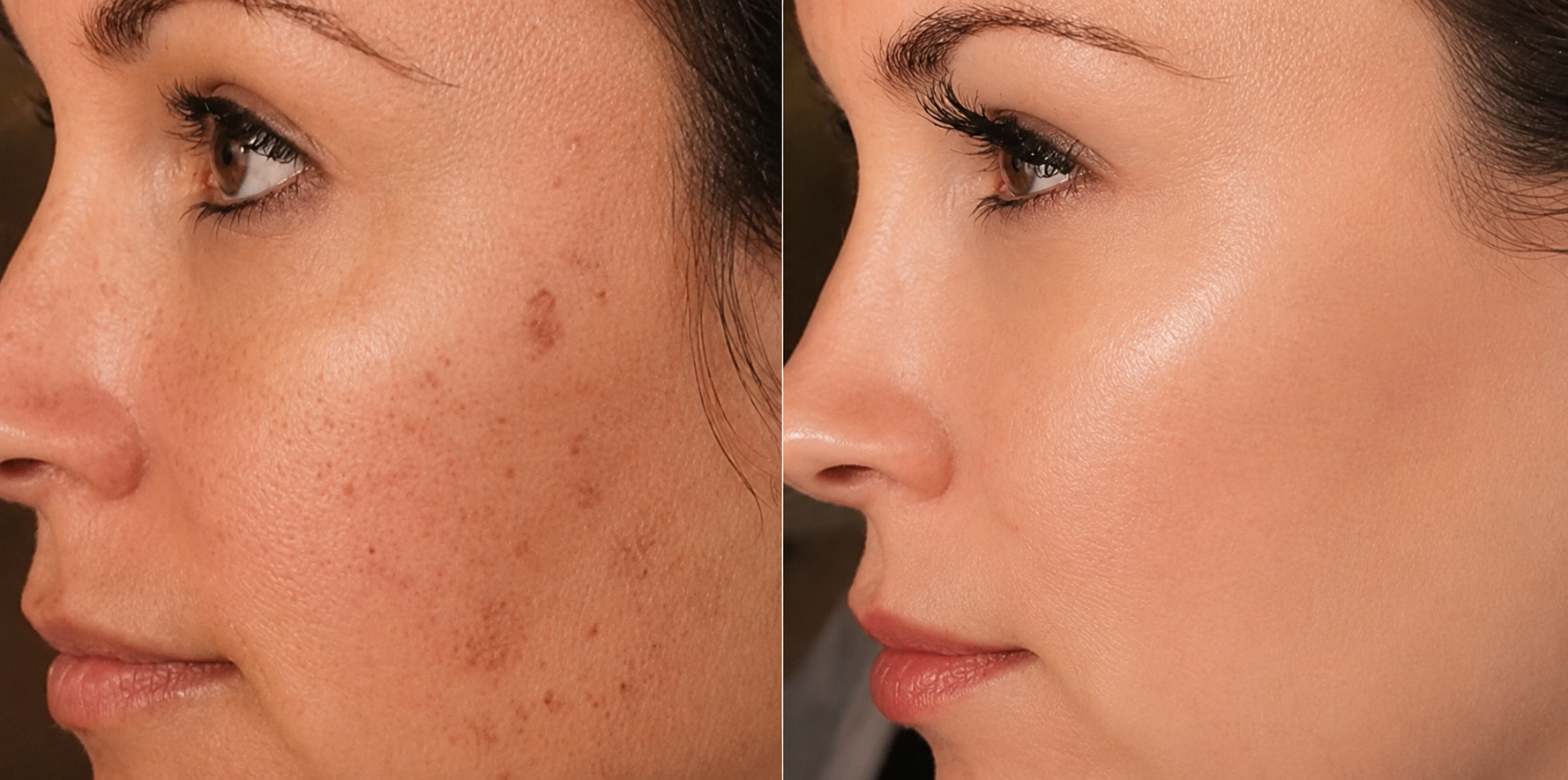 Before and after microneedling results showing reduced pigmentation