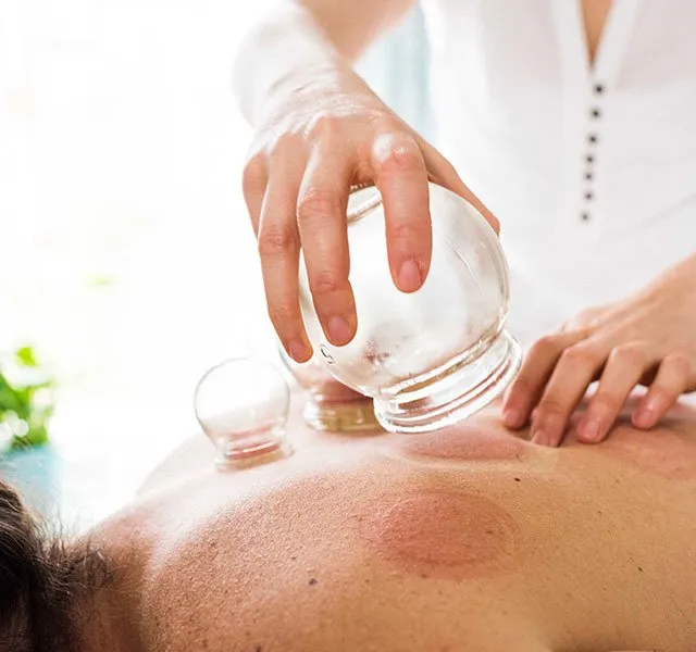 Benefits of Cupping Therapy