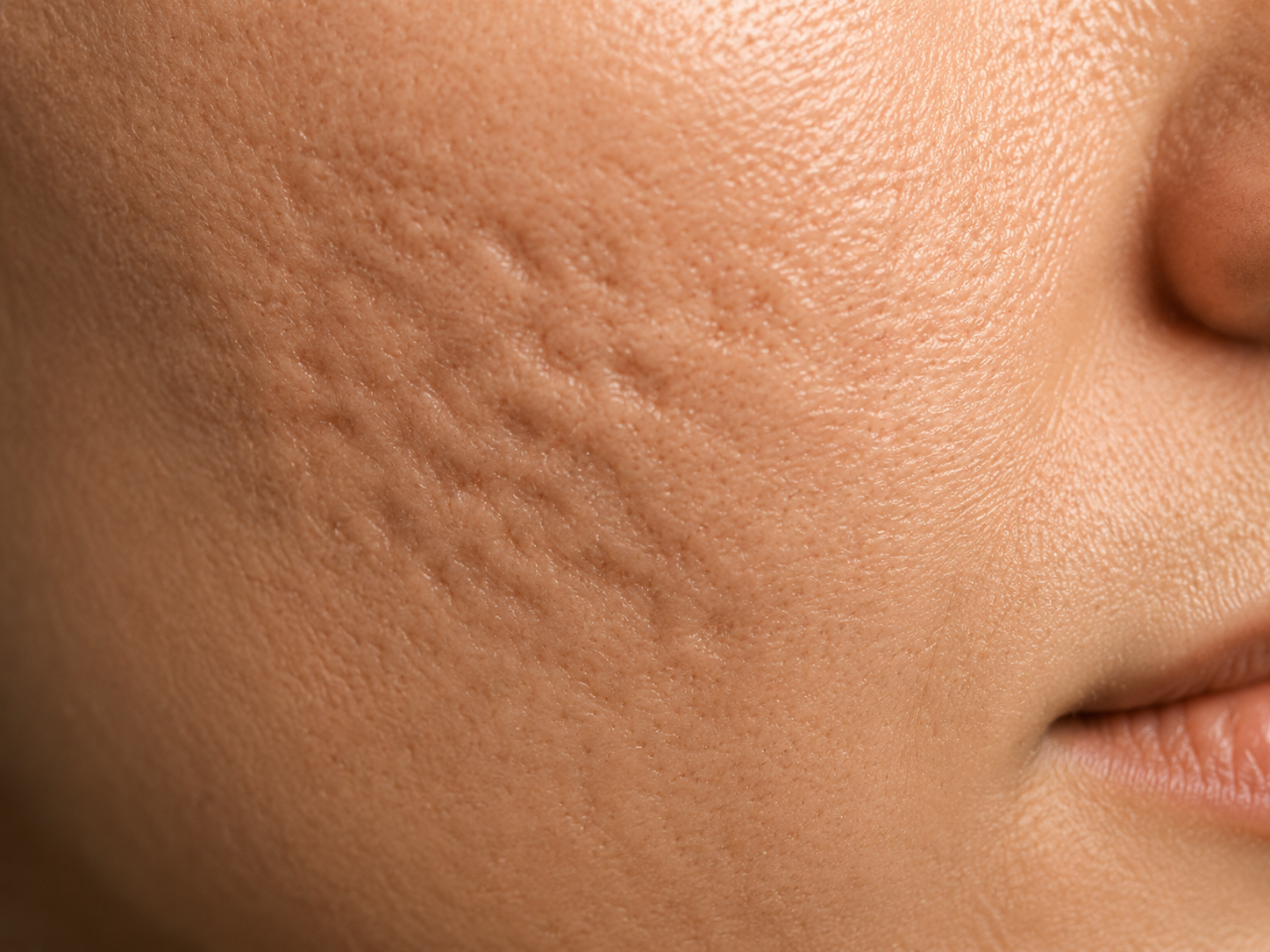 Acne Scars & Texture — microneedling treatment area